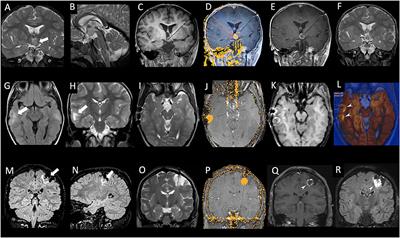 Magnetic Resonance-Guided Laser Interstitial Thermal Therapy (MR-gLiTT) in Pediatric Epilepsy Surgery: State of the Art and Presentation of Giannina Gaslini Children's Hospital (Genoa, Italy) Series